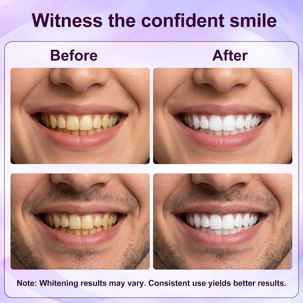 Teeth Whitening Strips