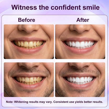 Teeth Whitening Strips